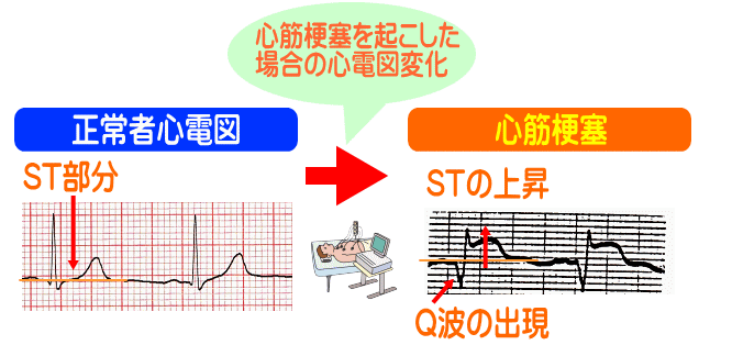 心筋梗塞を起こした場合の心電図変化