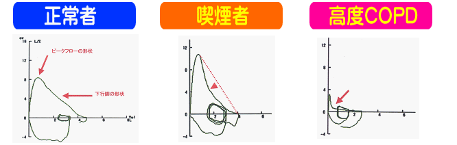 フローボリューム波形パターン