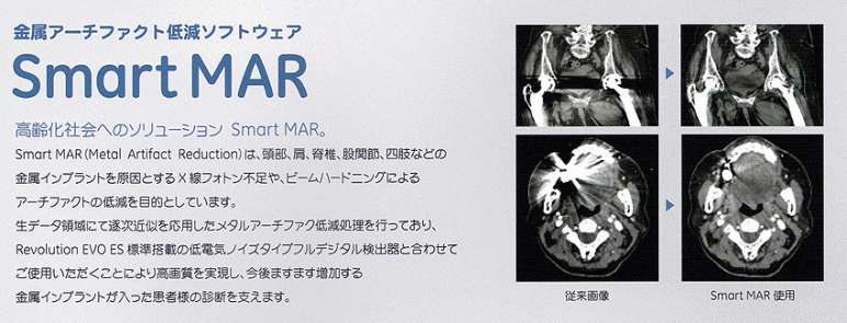 金属アーチファクトの低減